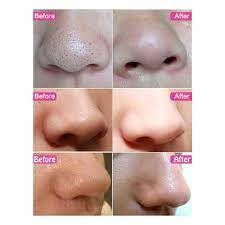 This will extract the blackheads from . Nour Co Tea Tree Deep Cleansing Nose Pore Strips From Facebook