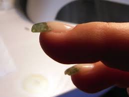 Fußnägel können sich sehr vielfältig verformen: Nach Oben Wachsende Nagel Kurzes Nagelbett