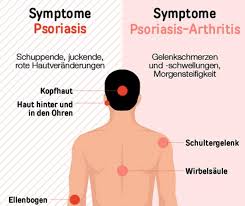 Les symptômes du coronavirus sont des maux de gorge, courbatures, difficultés respiratoires. Schuppenflechte Auf Der Kopfhaut Psoriasis Info