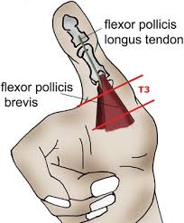 The veterinarian also checked the deep digital flexor tendons and suspensory ligaments (king and mannsman, 2005). Injuries Of The Flexor Tendons Musculoskeletal Key