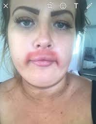 Egg white mask for upper lip hair removal. Woman Left With Embarrassing Burns After Moustache Removal Cream Disaster Heart