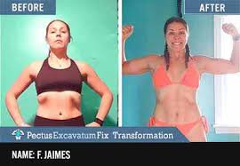 Kants werk „kritik der reinen vernunft: 10 Proven Ways To Fix Flared Ribs Without Surgery In 2020 More