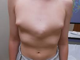 Consult a doctor for medical advice. Dynamic Compression Device Brace Rocky Mountain Pediatric Surgery