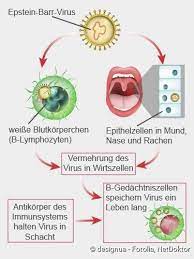 Die mandeln und die rachenschleimhaut sind auch bei der häufigsten form der diphtherie, der rachendiphtherie, zunächst gerötet und geschwollen, dann bilden sich weiße beläge mit entzündlichen wucherungen. Pfeiffersches Drusenfieber Symptome Ansteckung Verlauf Netdoktor