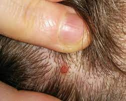 About a year ago while i was driving, i brushed my hand through my scalp and noticed that i had 'tiny hard little brittle hairs' almost like after you get a buzz cut, on my scalp. What Is This On The Back Of My Head Ingrown Hair Popping