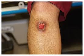 J am acad dermatol 1996; An Atypical Presentation Of Lupus Vulgaris Cmaj