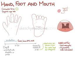 Hand Foot Mouth Disease From Hell