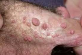 Image result for genital warts
