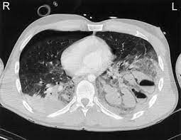 Collapsed lung (pneumothorax) a collapsed lung occurs when air gets inside the chest cavity (outside the lung) and creates pressure against the lung. Pneumothorax Knowledge Amboss