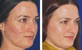 micro needling treatment