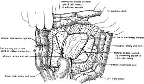 The mortality rate was 2.5%.conclusion: Esophageal Replacement With Colon Interposition Operative Techniques In Cardiac And Thoracic Surgery