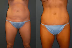 We did not find results for: Can I Get A Tummy Tuck If I Ve Never Been Pregnant Dr Matthew Conrad