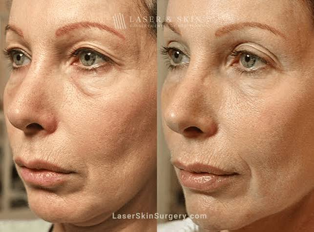 Laser hair removal treatment at Profrea
