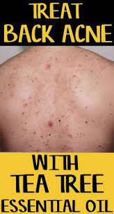 Tea Tree Oil For Bacne Tea Tree Oil For Acne Tea Tree Oil Uses Tea Tree Oil