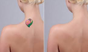 It generally works by pointing lasers at the tattoo and breaking how much does it cost to remove a tattoo? Laser Tattoo Removal How Many Sessions Does It Take Paradise Med Spas Of Texas