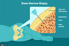 Bone Marrow Biopsy: Uses, Side Effects, Procedure, Results