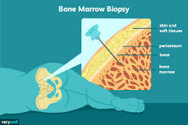 Bone Marrow Biopsy Uses Side Effects Procedure Results