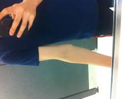 Why Does My Inner Elbow Stick Out So Far Bodybuilding Com Forums