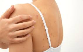 Acne is most common on the face, neck, back, shoulders, and chest. How To Remove Acne On The Back In Simple Ways Skinkraft