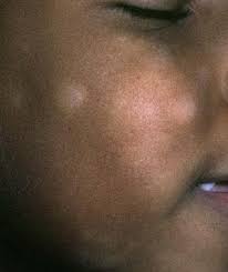 Image result for Postinflammatory Hypopigmentation