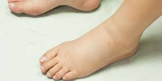 Dah urut guna minyak panas pon masih rasa lenguh kaki lagi. 10 Cara Mengatasi Kaki Bengkak Saat Hamil Perhatikan Konsumsi Harian Merdeka Com