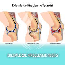 eklemlerde kireclenme nedir eklemler uzerinde gorulen kireclenme