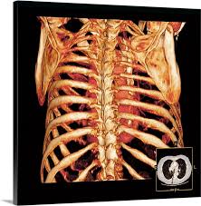 It encloses the thoracic cavity, which contains the lungs. Rib Cage And Heart 3d Ct Scan Wall Art Canvas Prints Framed Prints Wall Peels Great Big Canvas