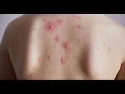 pin on hidradenitis suppurativa