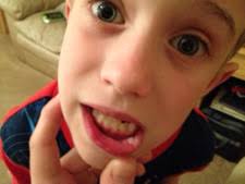 Hence, why palatal or lip wound can heal very quickly and less prone to infection can be explained as follow: Bit Lip Split Lip How To Treat Mouth Injuries In Children