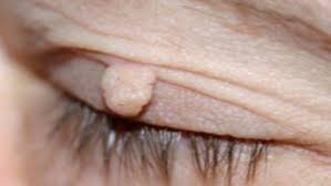 Image result for xantelasma