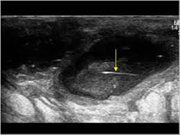 It's like a nasty but nice to see it come out like that! Musculoskeletal Joints And Tendons 6 5 Hip Groin And Buttock Case 6 5 9 Buttock Ultrasound Cases