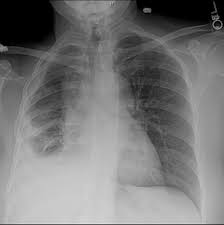 Malignant Mesothelioma