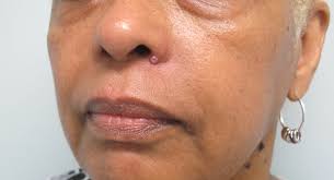 06.10.2018 · if you have darker skin, it can look tan, black, or brown. Skin Cancer Photo Gallery