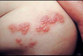 The infection caused by hsv type 1 involves the areas like mouth, lips, nose and face. Pictures Of Viral Skin Diseases And Problems Herpes Zoster