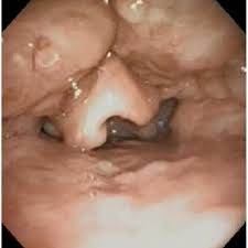 The arterial supply to the lingual tonsil is largely via the lingual artery, with contributions from the tonsillar branch of the facial. Lingual Tonsil Hypertrophy Visualized On Sleep Endoscopy Download Scientific Diagram