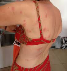 Image result for Cimex lectularius bites