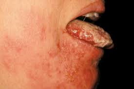 Image result for Oral herpes roof of mouth