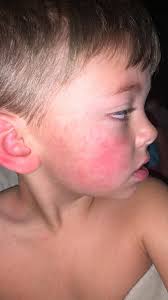 Fifth disease virus symptoms and precautions