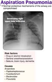 Aspiration Pneumonia Anaerobes Radiology Medicine Student Radiology Imaging