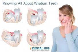 Pin On Wisdom Teeth Pain
