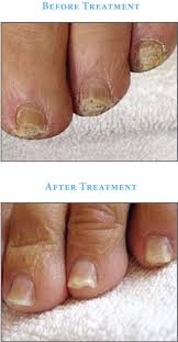 Image result for onychomycosis