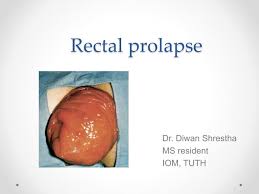 Image result for Rectal prolapse