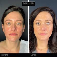 Umm- have you seen Sarah from our office lately? She had a lil’ refresh  done and looks amaze! Dr. Zamora did Sarah’s FAMI Fat Transfer and Jackie  did her Opus InfiniVive Facial. These results are ...
