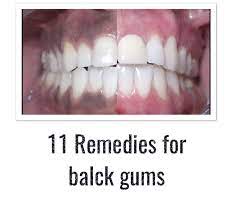 11 Remedies For Black Gums Natural Care Skin Care Recipes Black Gums Gum Care