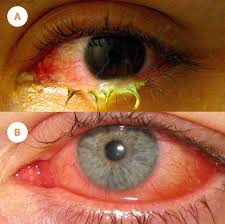 Image result for Viral Conjunctivitis