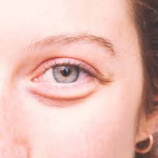 This video will show you how to wash & flush out your eye after getting soap, tonner, dead skin, chemical peel, eyelash glue, metal objects from a crappy. How To Get Rid Of Bags Under Eyes 13 Natural Ways Dr Axe