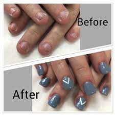 Not A Nail Biter Results Of Bad Acrylic Possibly Illegal Product 6 Mo Ago Beware Of What Products Techniques Are Used On Gel Nail Designs Nails Gel Nails