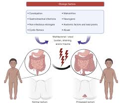 Image result for Rectal Prolapse