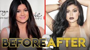 Yes, we are going to present you some images with highights how kylie jenner before plastic. Kylie Jenner Before After Transformation Lips Plastic Surgery And Workout Youtube