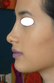 Les réponses esthétiques doivent toujours prendre en compte le paramètre psychologique. Rhinoplastie Naturelle Suites Operatoires Et Retouches Chirurgien Esthetique Experimente A Paris